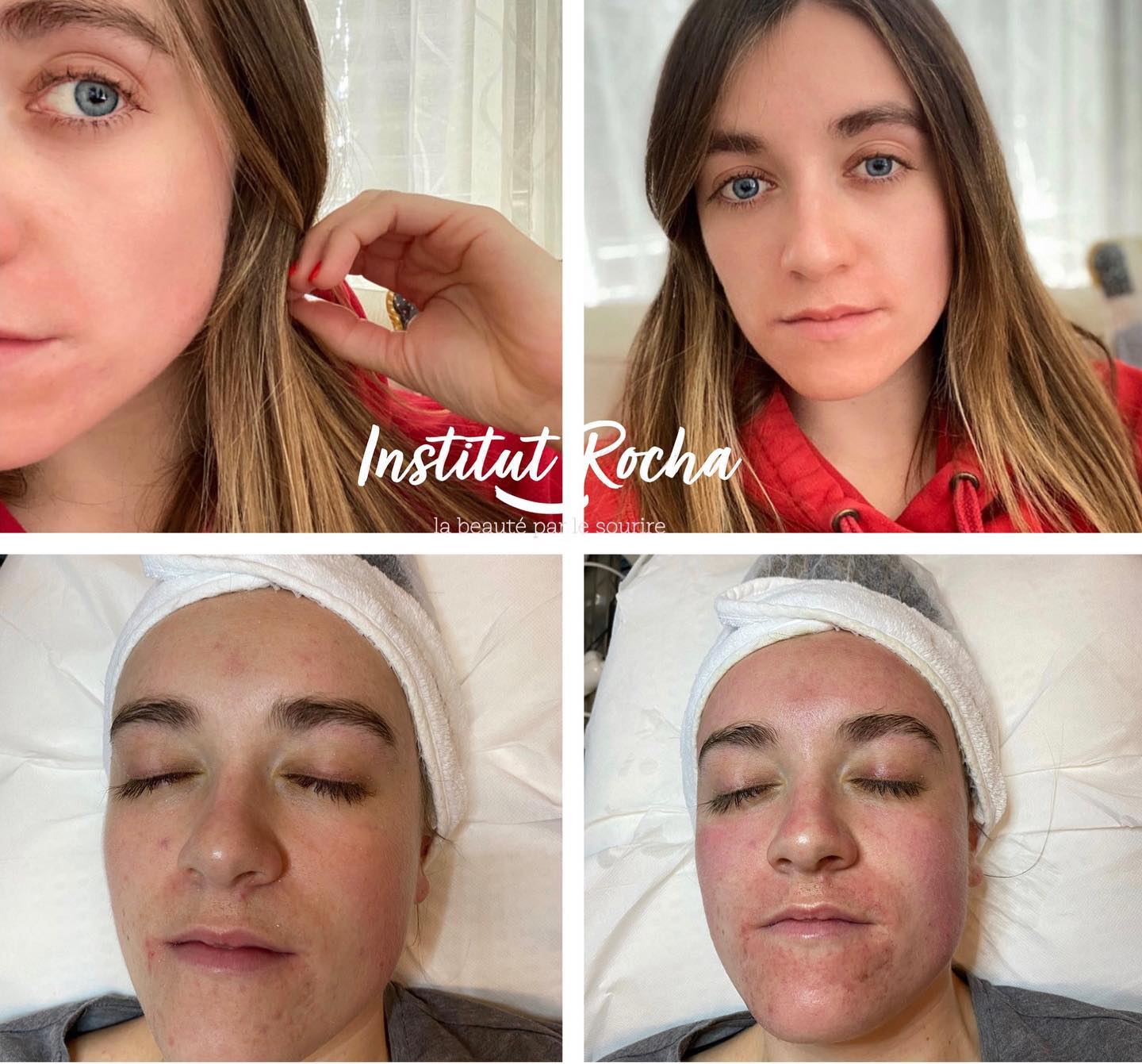 Microneedling
